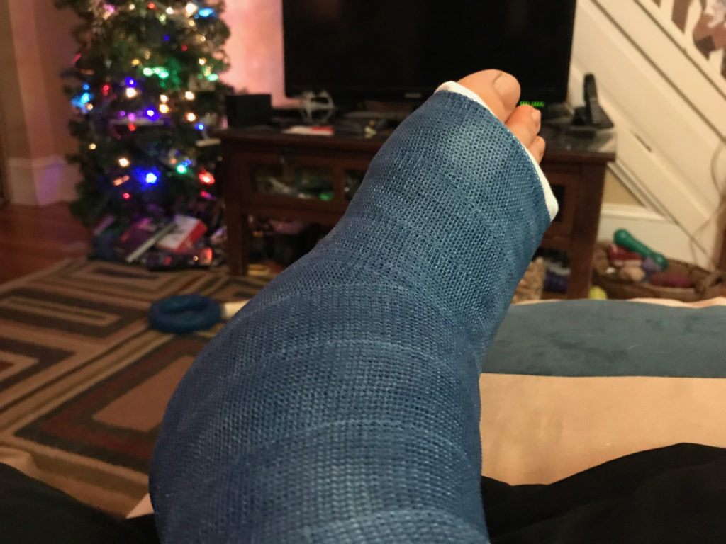 A right ankle in a blue cast